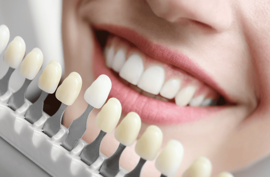 Get a brilliantly white smile with professional teeth whitening in Tarzana. Safe, effective treatment to get the Hollywood smile patients love!