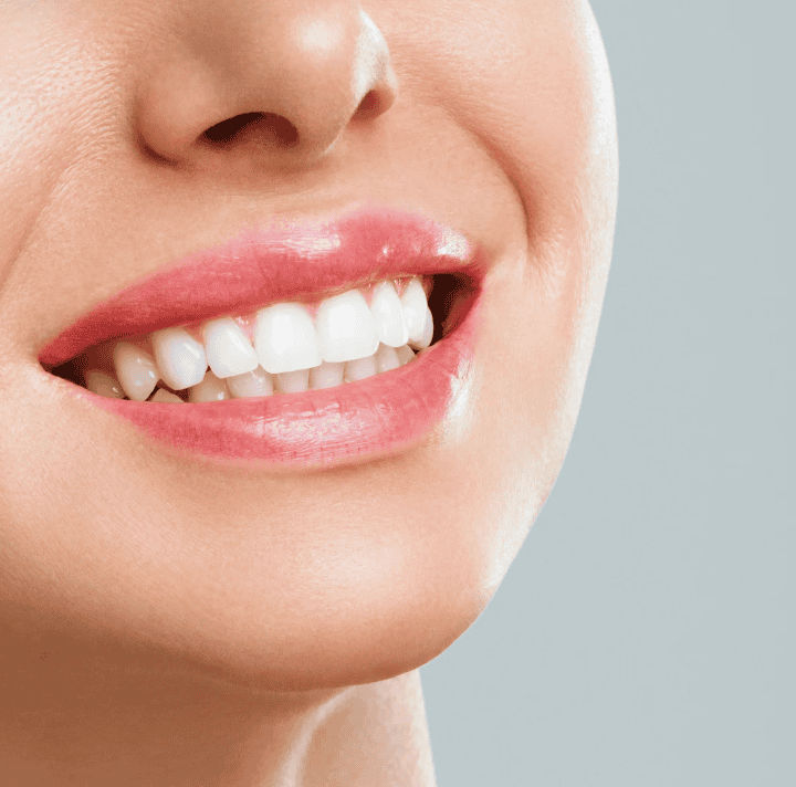 Dental Bonding in Tarzana CA
