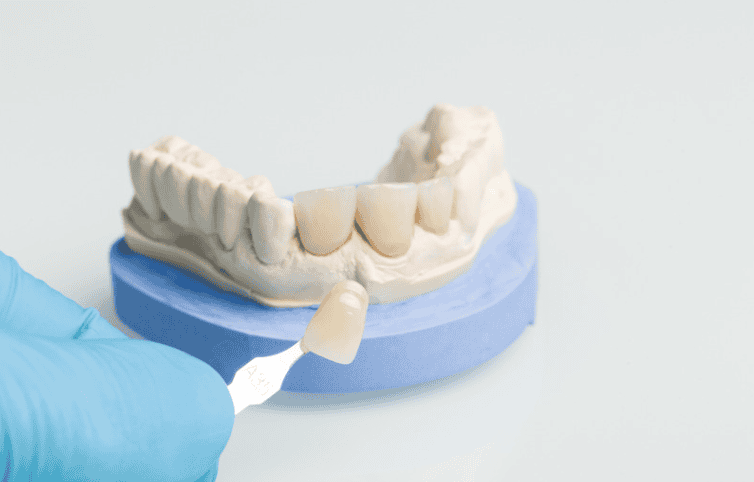 Dental Crowns in Tarzana Ca