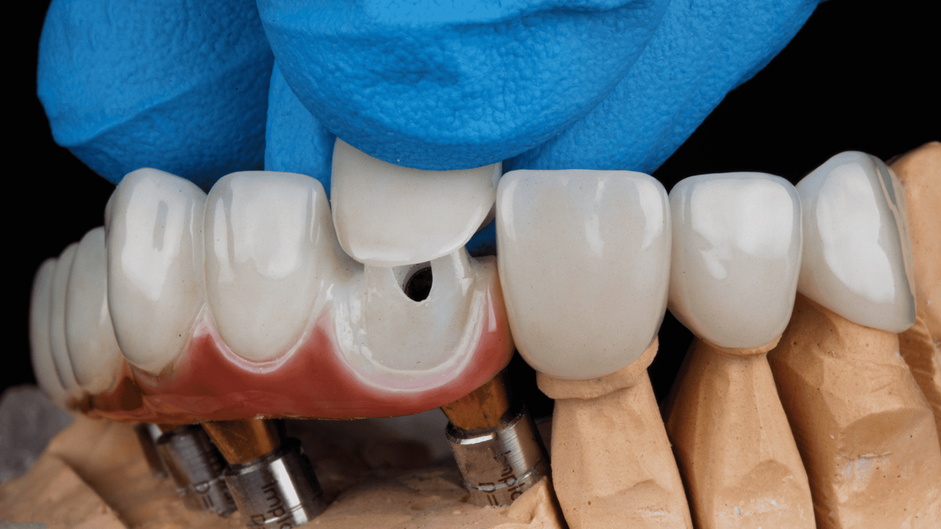Get your smile back with dental crowns in Tarzana. Custom-crafted to match your natural teeth perfectly, strong, beautiful, long-lasting. Call today!