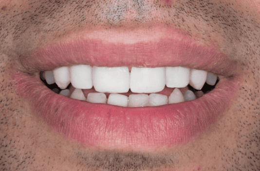 Dental Implants by Dental Plus Tarzana