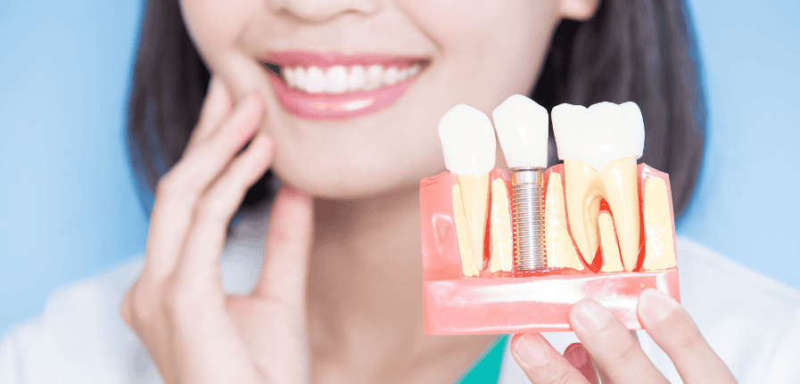 Dental Implants in Tarzana CA