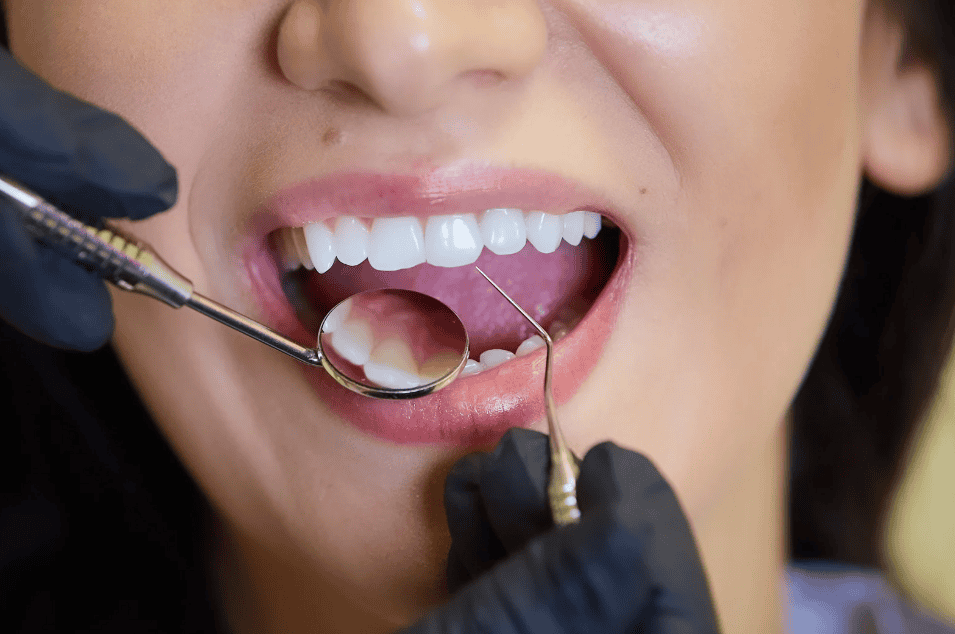 Dental Inlays & Onlays in Tarzana CA
